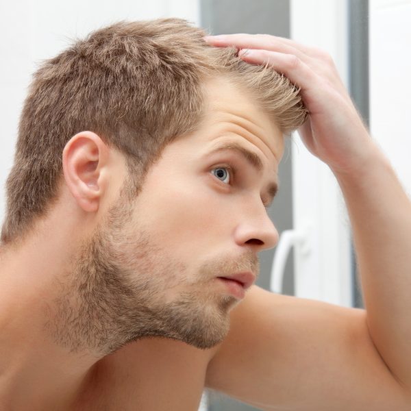 Hair Loss Management for Men