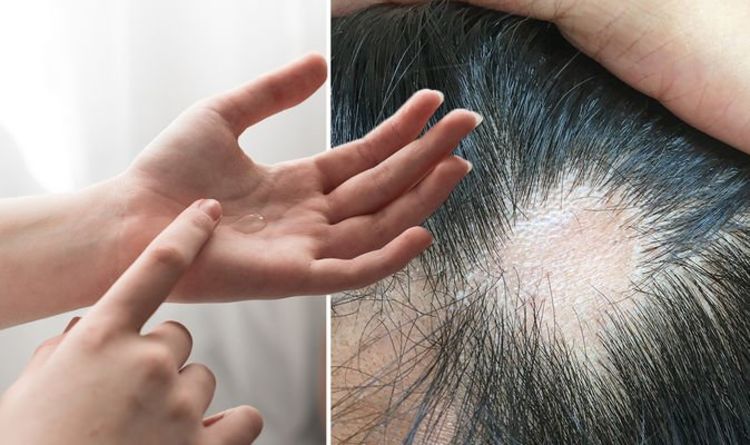 Hair loss: Treatment for alopecia includes melatonin
