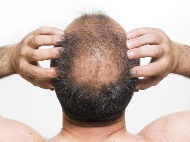Hair Loss Treatment for Steroid Users  Steroid Cycles