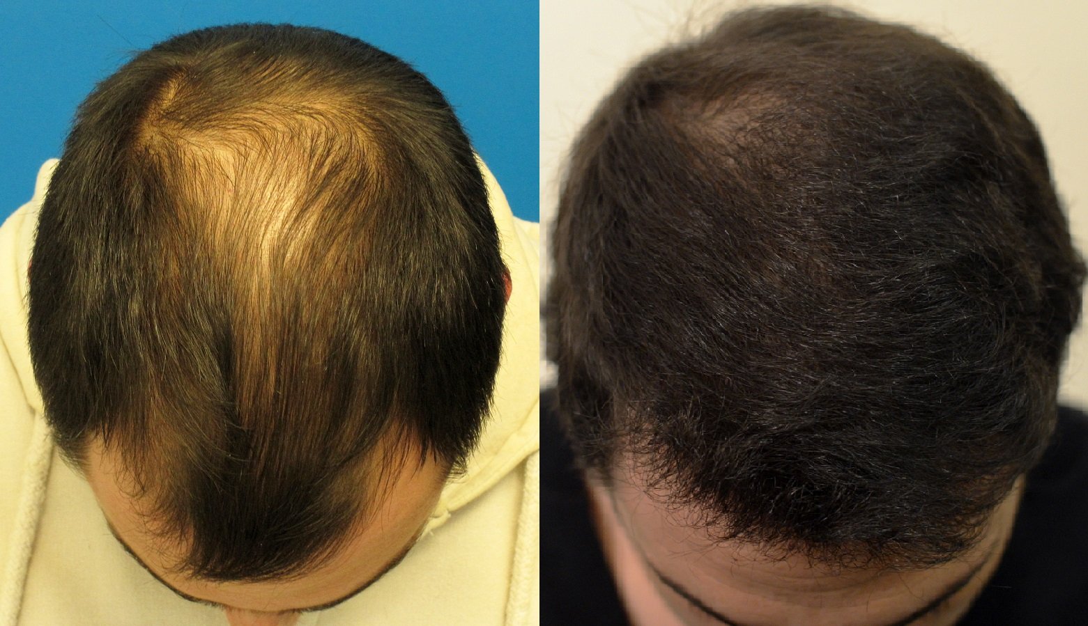 Hair loss treatment