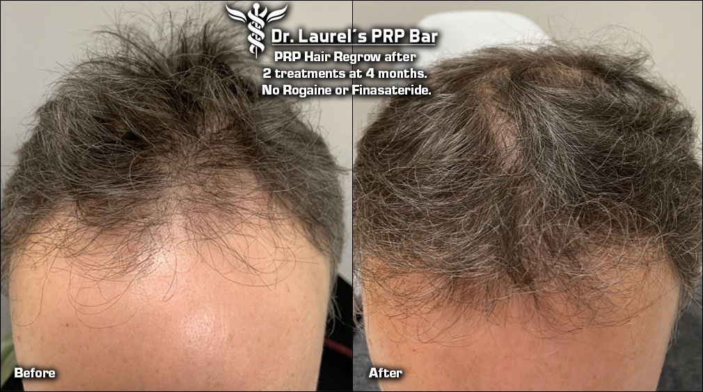 Hair Regrow by Dr. Laurel in Cleveland, Ohio.