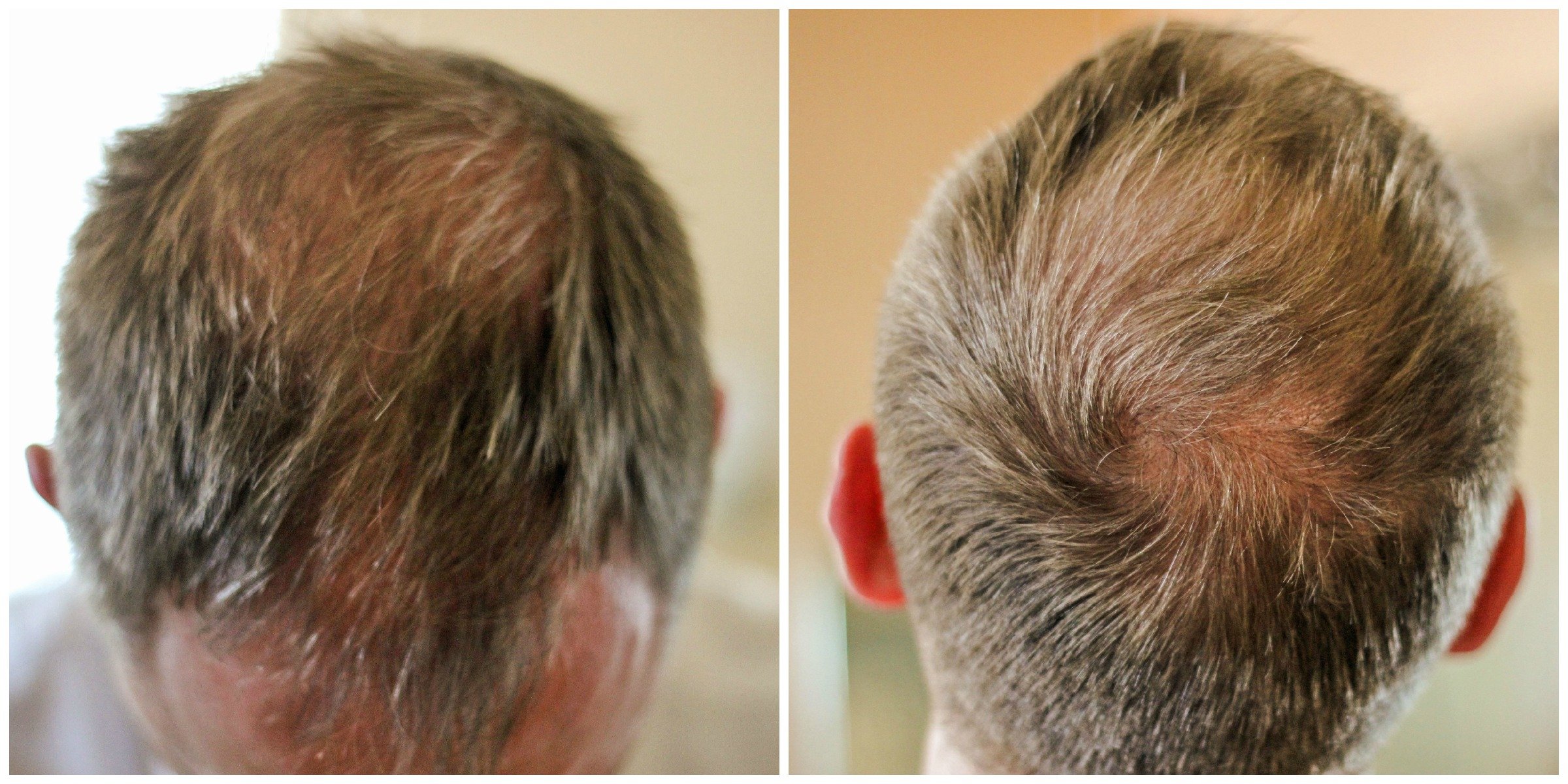 Hair Thinning and Hair Loss: What