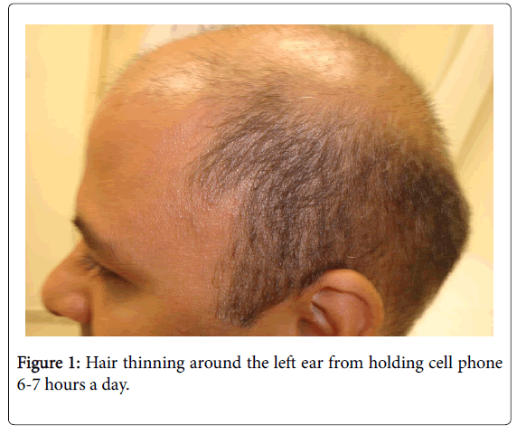 Hair Thinning In The Front