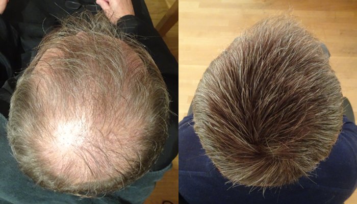 Hair Thinning On Crown