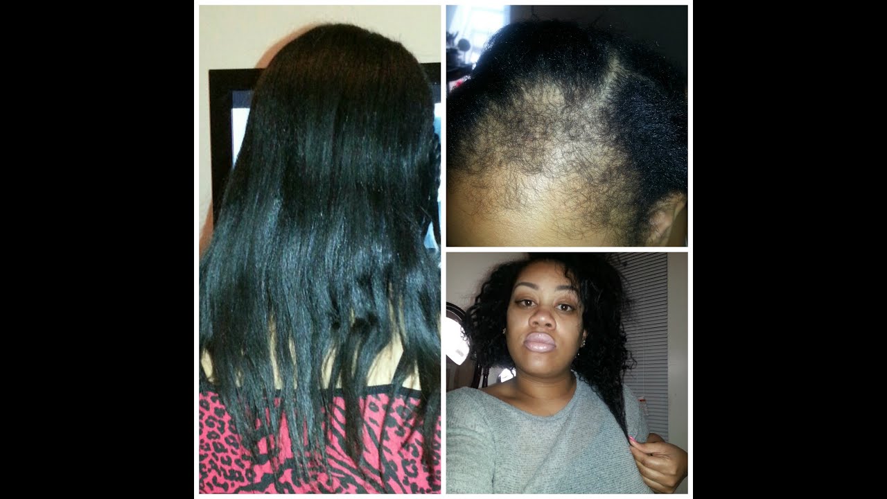 Hair woes: Postpartum alopecia hair loss, Hairfinity, Hair ...
