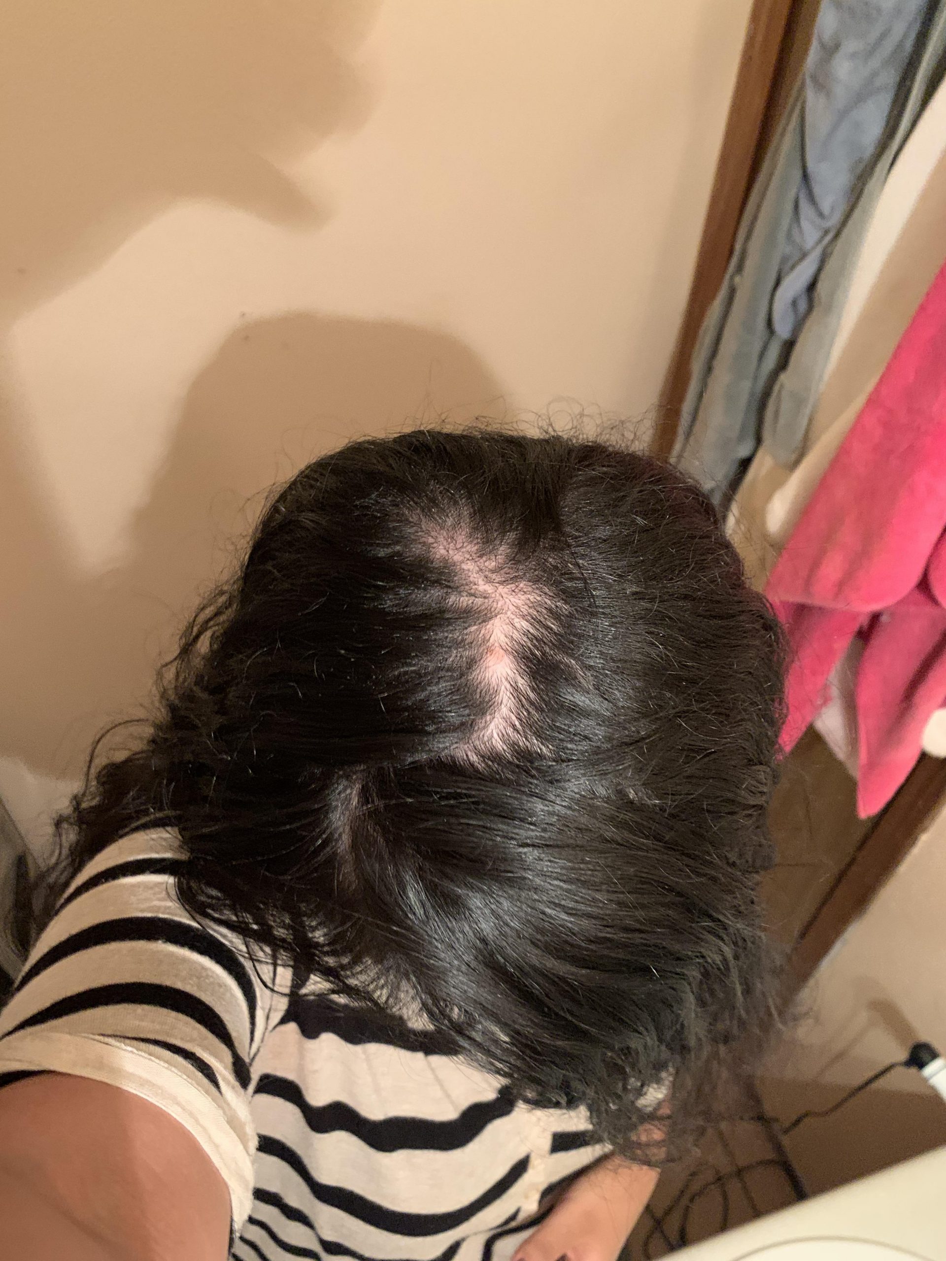 Help! Has anyone had this type of hair loss? I dont know what to do to ...