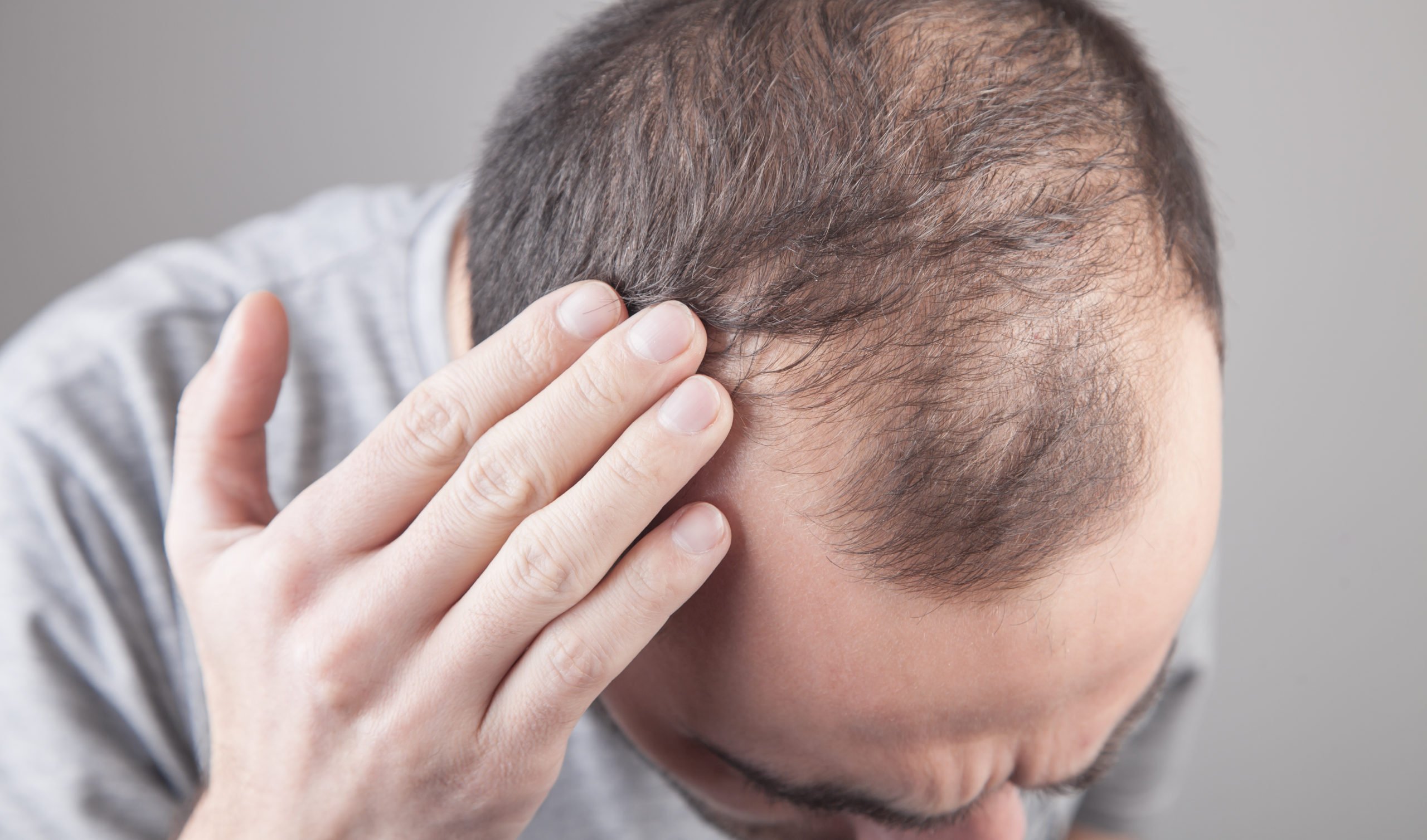 Hereditary hair loss: How to tackle genetic hair loss Elithair