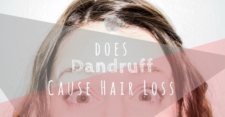 Hmmmmm? Does Dandruff Cause Hair Loss? {Let