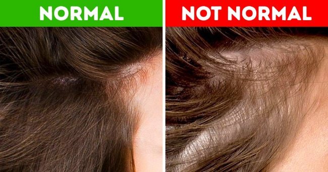 How Can I Stop Hair Loss after Being pregnant?