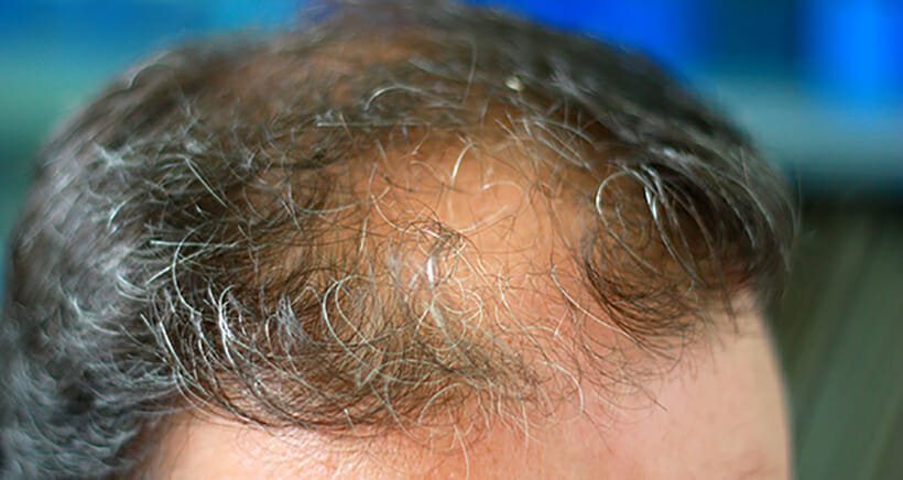 How Can PRP Help with my Hair Loss by Stimulating Hair ...