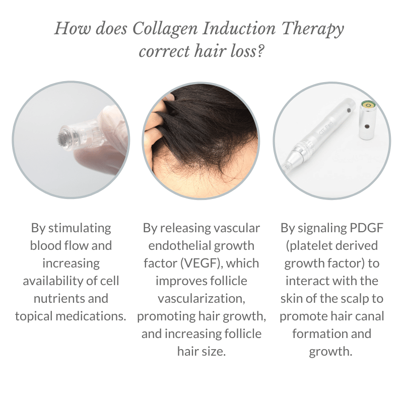 How Does Collagen Induction Therapy correct hair loss