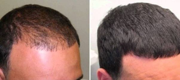 How does Rogaine work for frontal baldness?