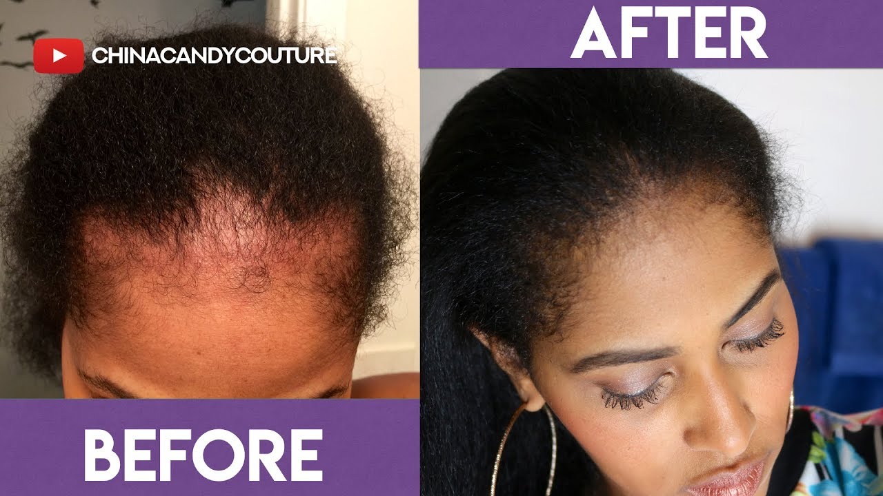 How i grew my edges back. How to Regrow Your Edges: Tips ...