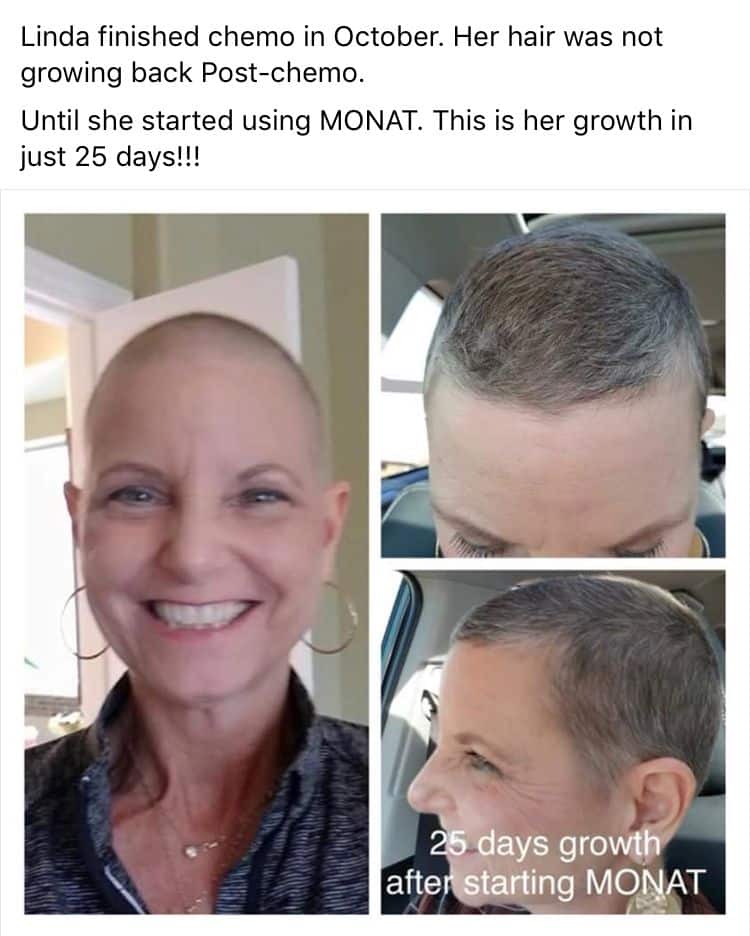 How Long After Chemo Will Hair Grow Back : How To Style Hair During ...