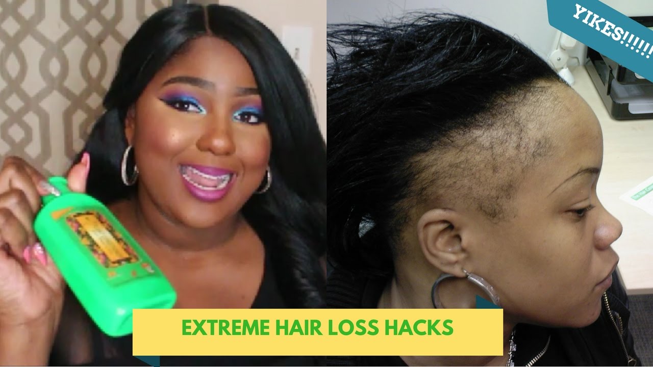 How long does hair loss last after gastric bypass ...