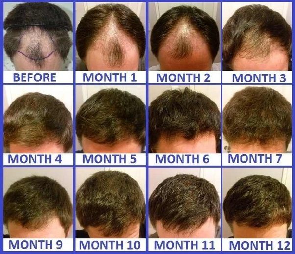 How long does it take for hair to grow after a hair transplant?