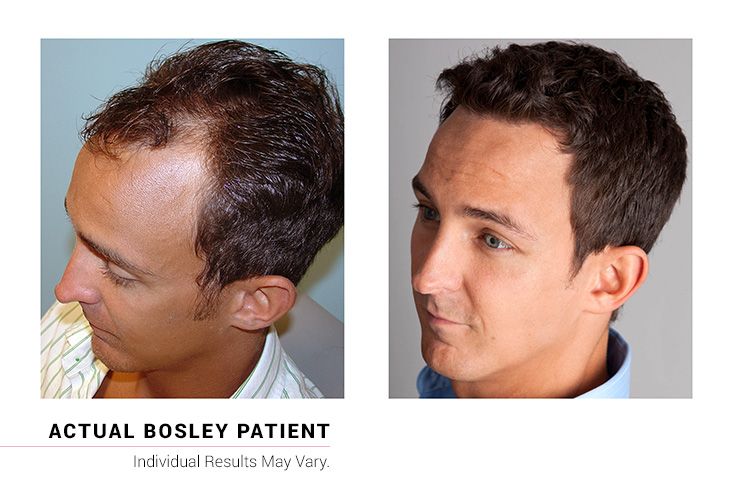 How Much Does a Hair Restoration Cost?