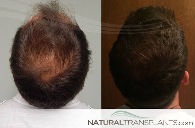 How Much Does A Hair Transplant Cost