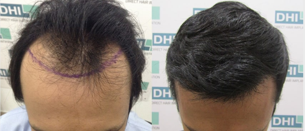How Much Does Hair Transplant Cost?