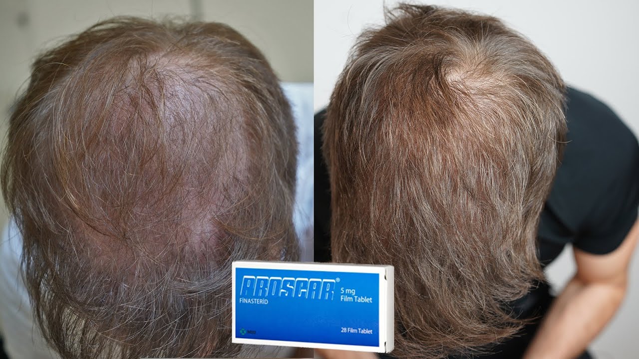 How Much Finasteride For Hair Loss