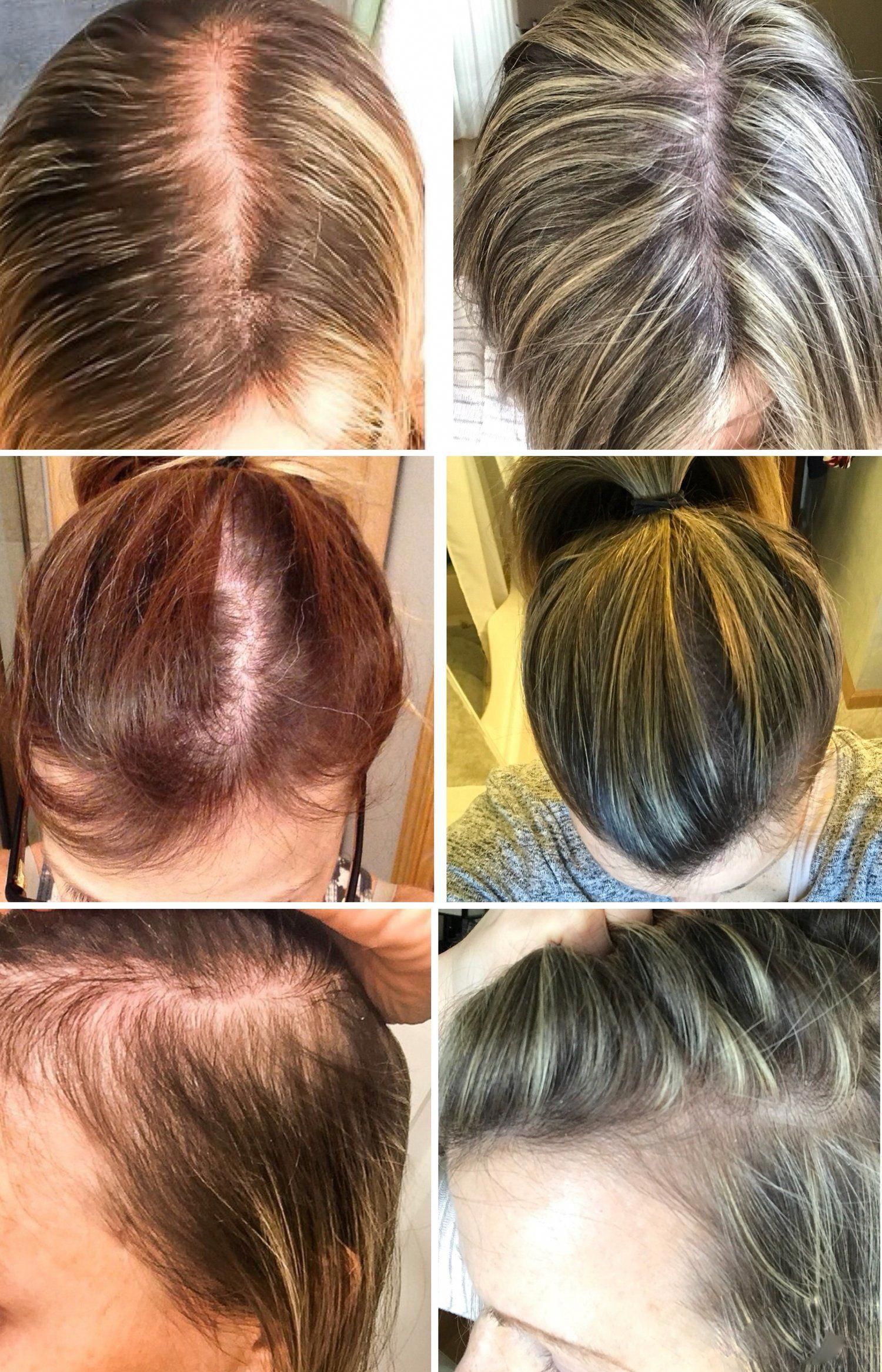 How Much Hair Loss Is Normal During Postpartum