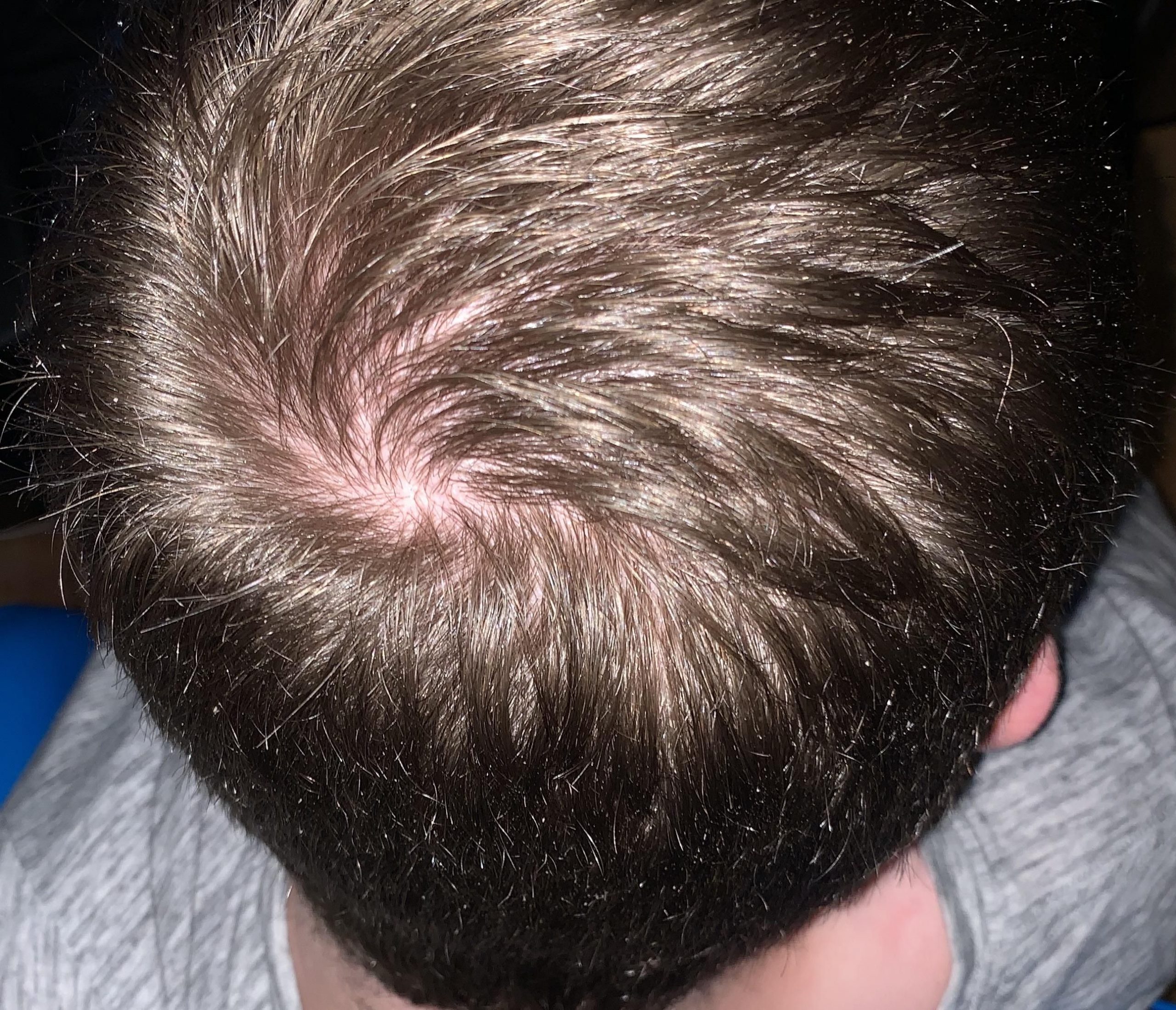 How Much Hair Loss Is Normal Male Reddit