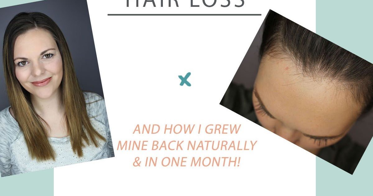 How Much Hair Loss Is Normal Post Pregnancy
