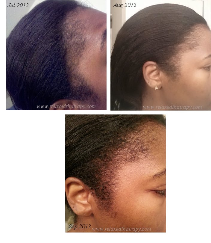 How Scalp Massaging with Oil Repaired My Thinning Edges