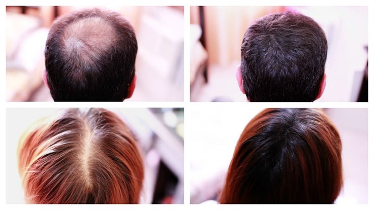 How to Cover Up Hair Loss, Bald Spots, Thinning Hair ...