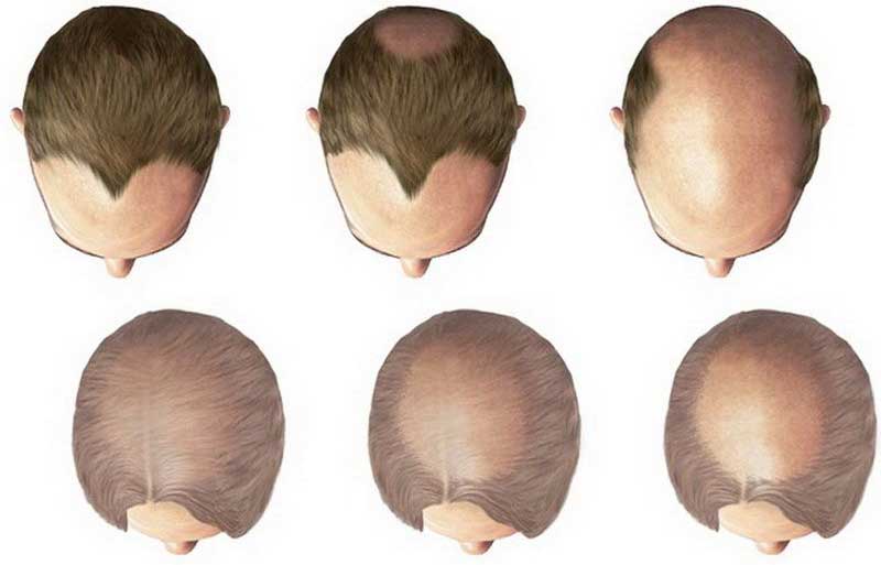 How to Deal with Androgenic Alopecia (AGA)