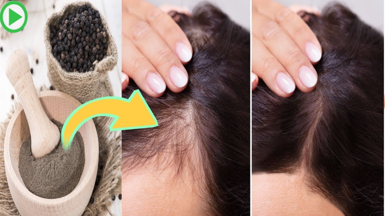 How To Get Rid Of Frontal Hair Loss At 20