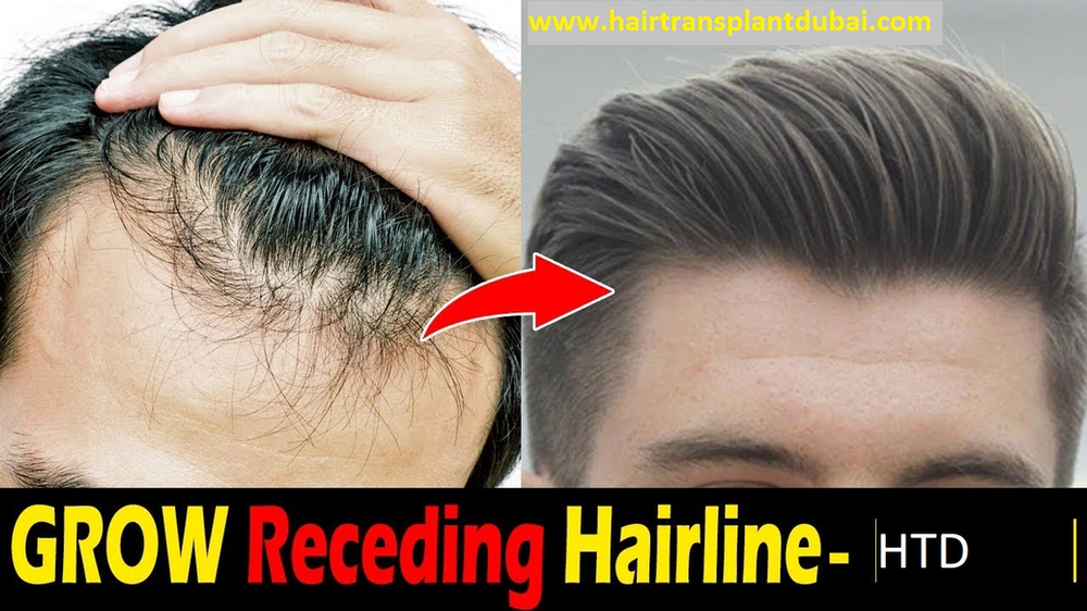 How to Grow Back Your Hairline Naturally?