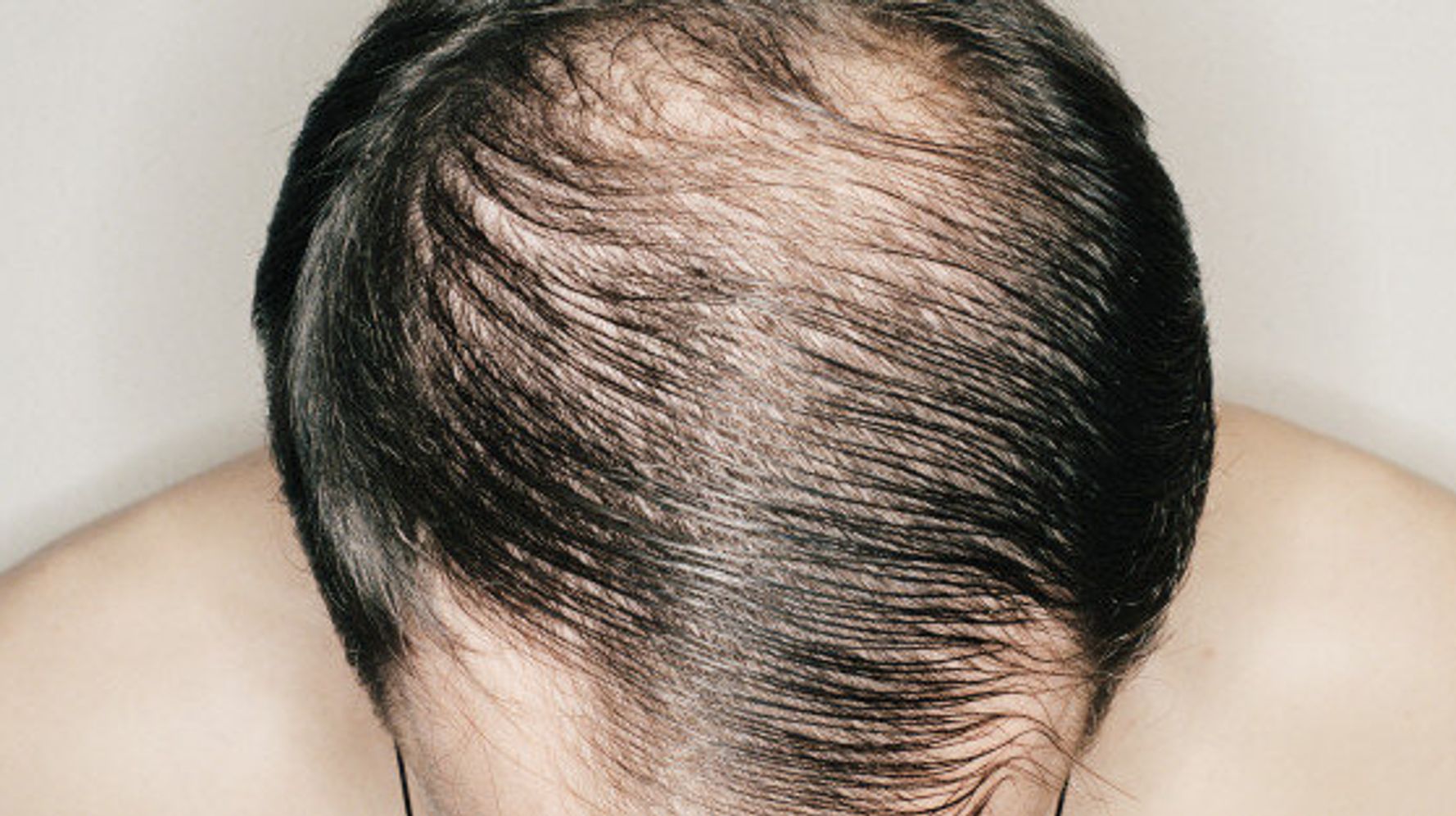 How To Know If Your Hair Is Thinning Male