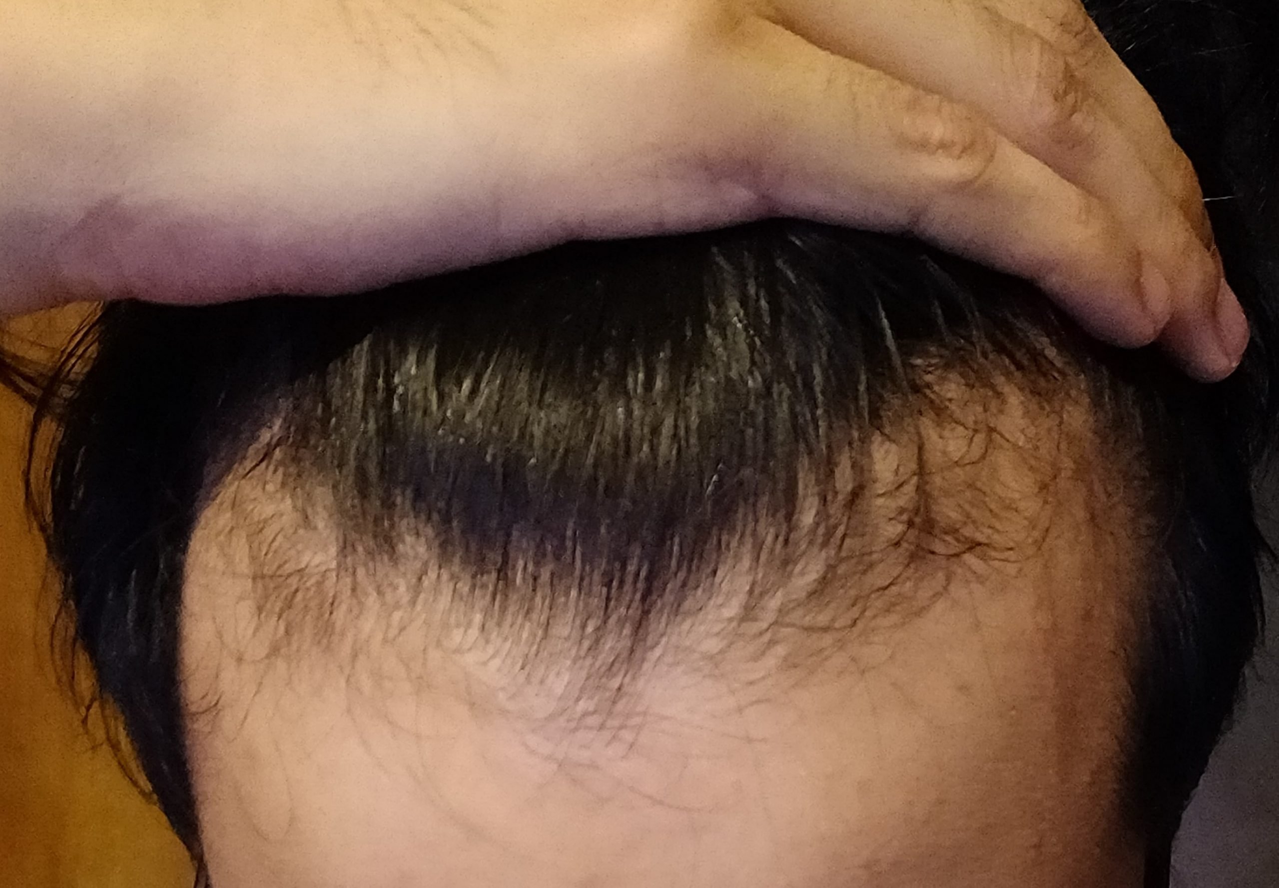 How To Know If Your Hair Is Thinning Reddit
