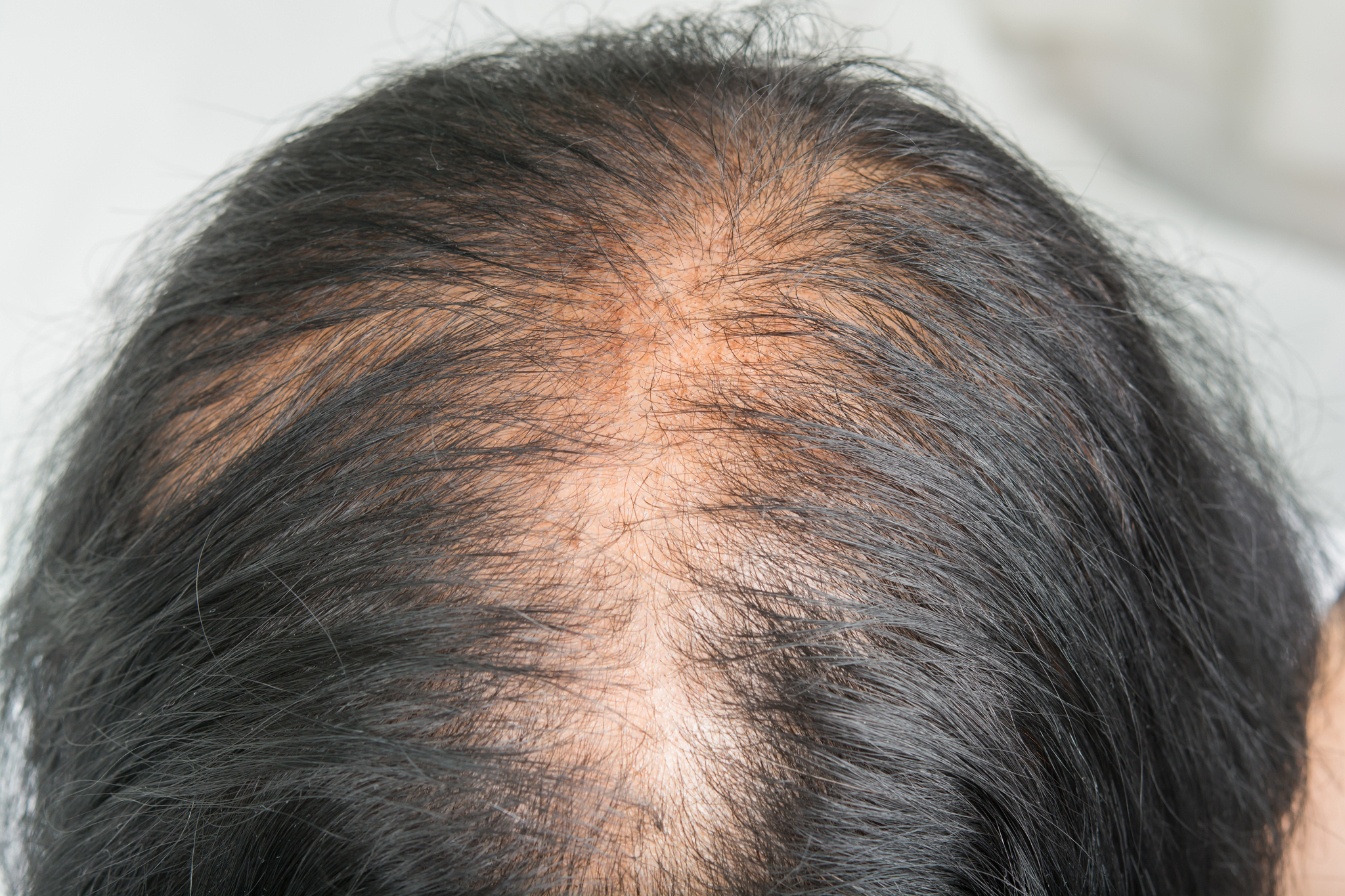 How to Prevent Dry Scalp Hair Loss  Royal Formula