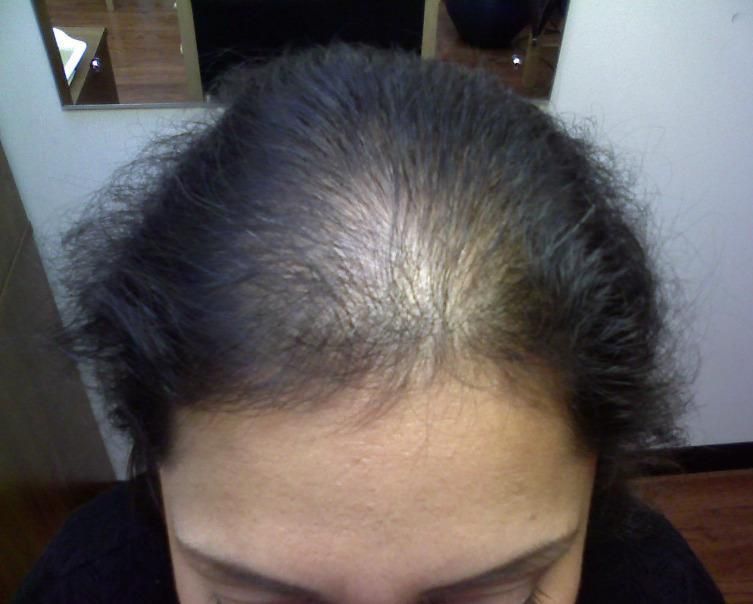 How To Prevent Hair Loss And Thinning Of Hair?