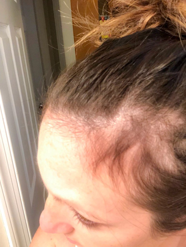How to Quickly Cover Bald Spots During Postpartum Hair ...