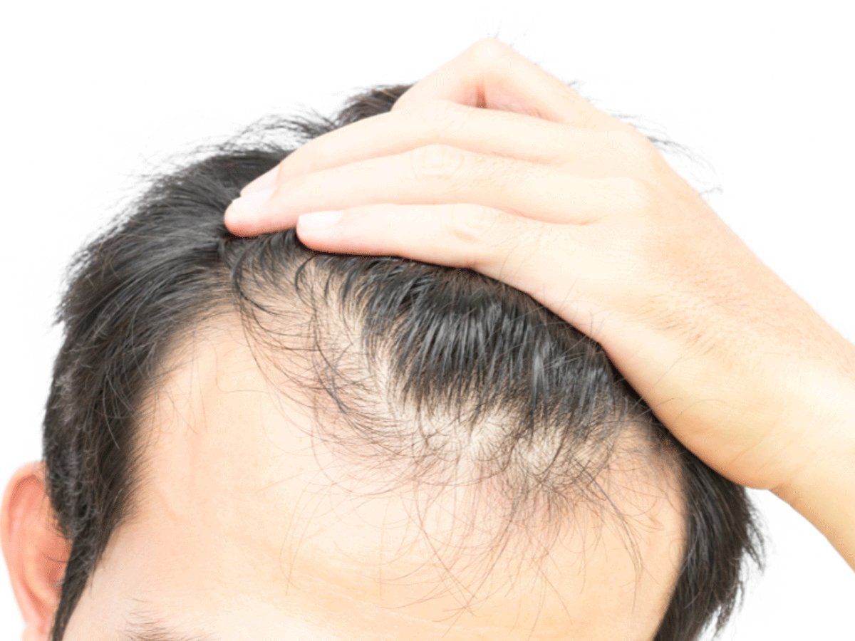 How to regrow hair on bald patches: The 4 best non