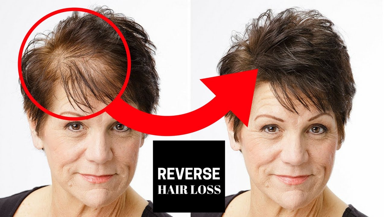 How to Reverse Hair Loss: 6 Secrets for Reversing Hair ...