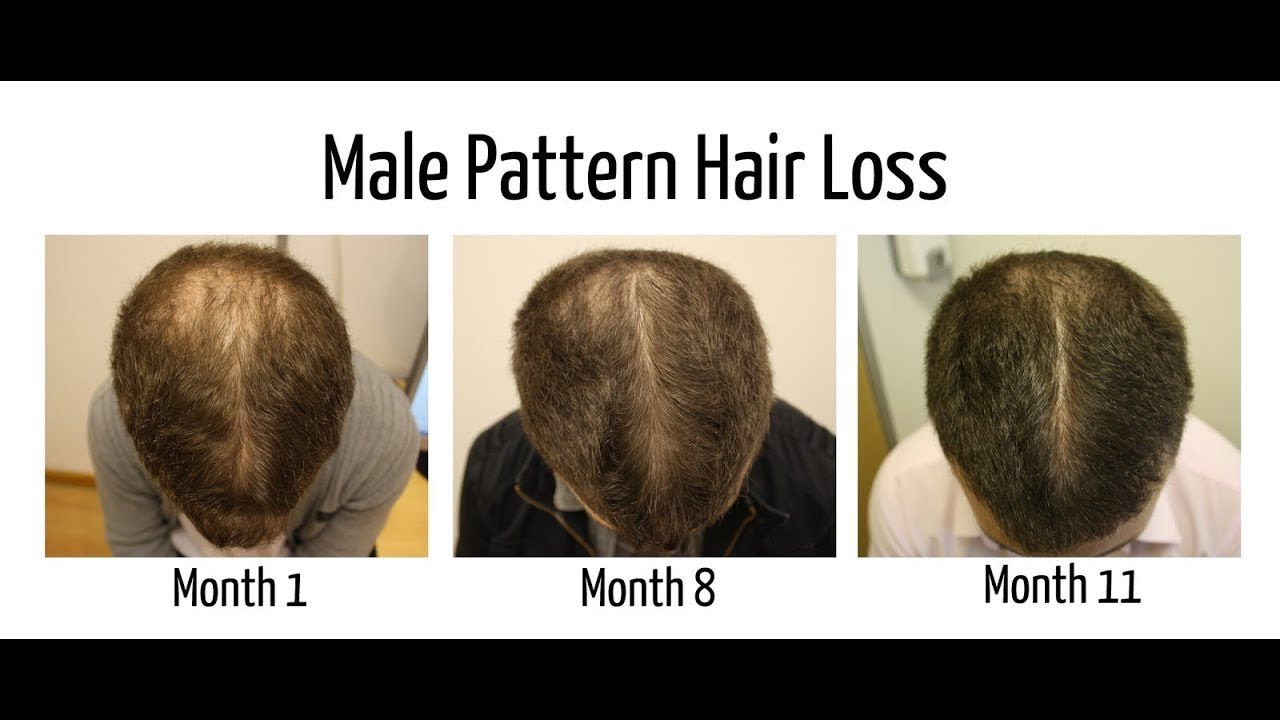 How to Reverse Hair Loss Naturally Testimonial