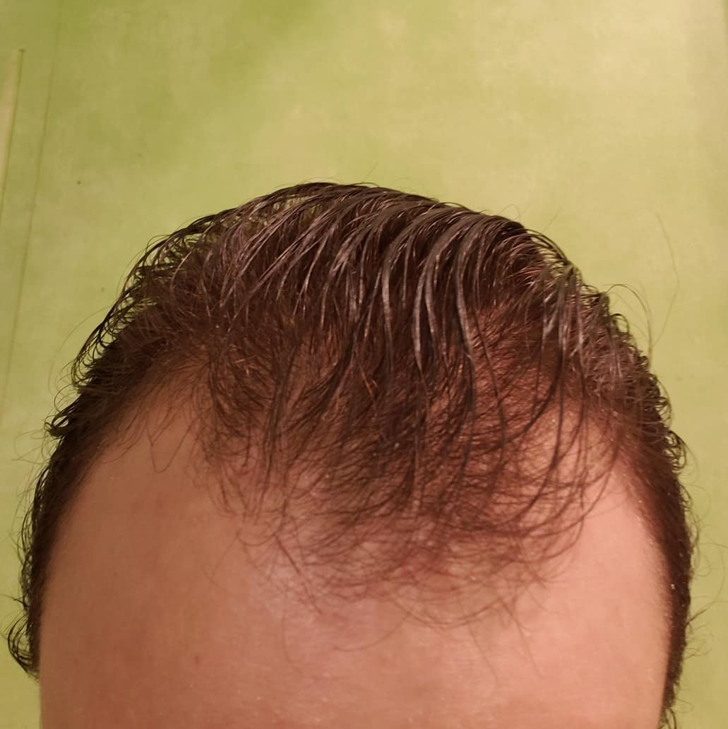 How to Solve The Problem of Hair Thinning at Front Male?