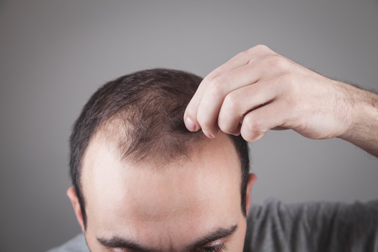 How to Stop and Regrow a Receding Hairline