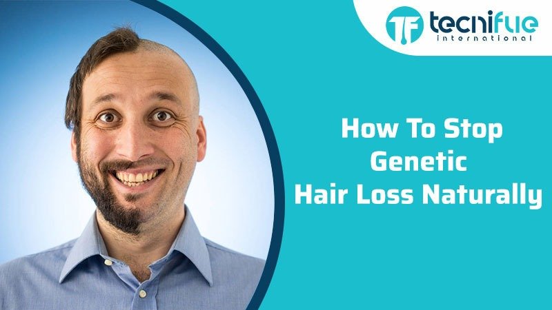 How To Stop Genetic Hair Loss Naturally » TecniFUE Best ...