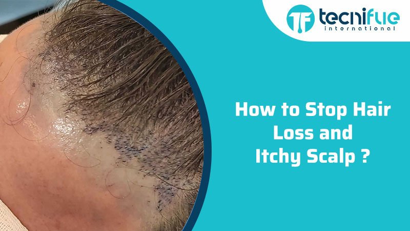 How to Stop Hair Loss and Itchy Scalp » TecniFUE Best Hair ...