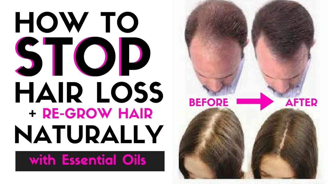 How to STOP HAIR LOSS &  Regrow Hair Naturally