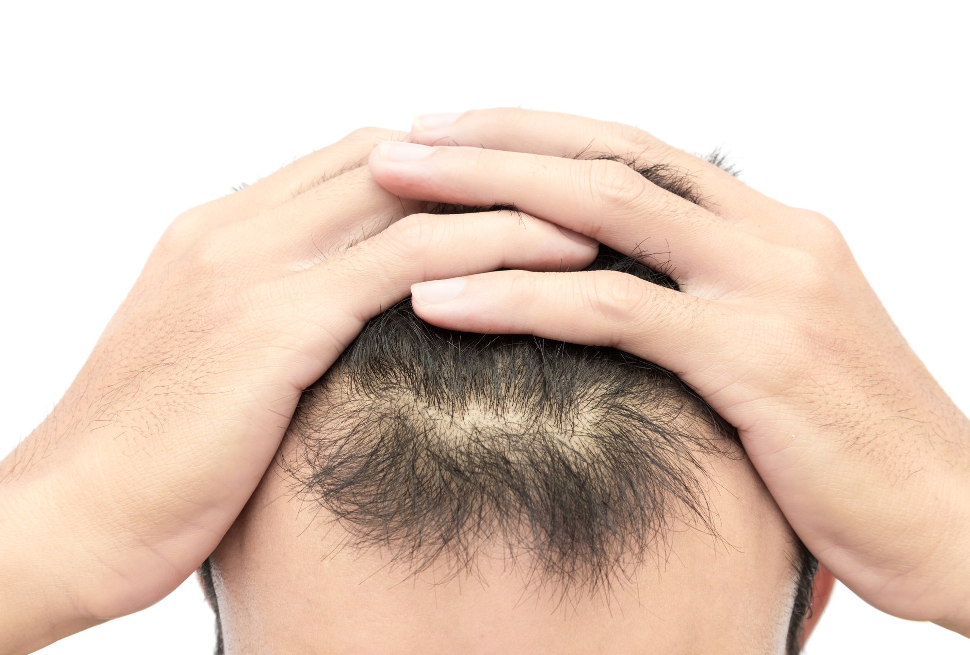 How to Treat Premature Baldness and Get Your Confidence ...