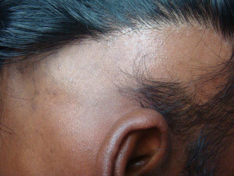 How to Treat Recurrent Patchy Hair Loss or Alopecia Areata ...