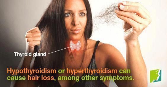 Hypothyroidism or hyperthyroidism can cause hair loss ...