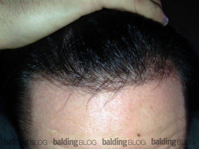 I Can See Scalp When My Hair is Wet (with Photos ...