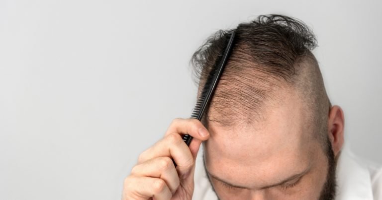 I Have Thinning Hair: Can I Still Get a Hairpiece?
